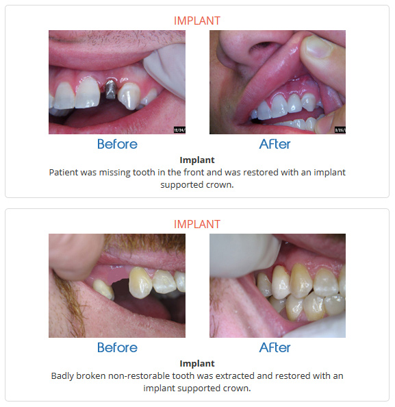 dental-implant-smile-gallery